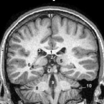 SHEC: La Sincronización de Hemisferios Cerebrales